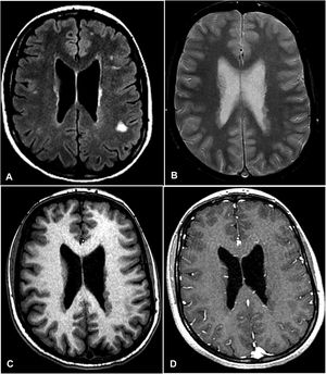 A. Secuencia FLAIR en la que se aprecian hiperintensidades subcorticales y algunas isointensas con la corteza cerebral, visibles también en la secuencia T2 de densidad protónica (B). C. En la secuencia potenciada en T1 se aprecia que las lesiones periventriculares se corresponden con imágenes nodulares isointensas con la corteza cerebral que no se realzan tras la administración de gadolinio (D). Las imágenes periventriculares son altamente indicativas de heterotopia cortical periventricular, mientras que las lesiones subcorticales hiperintensas en FLAIR tienen características inespecíficas y no son concluyentes para el diagnóstico de esclerosis múltiple.
