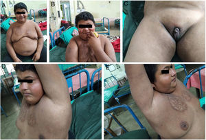 The patient had morbid obesity (A), dry skin (A–E), small testes (C), maldeveloped scrotum (C), lipomastia (A), and under-development of other secondary sexual characteristics (C–E). Besides, he had conjunctival congestion, facial plethora (especially malar flushing) (B), asymmetrical scar-like lesions over both sides of the anterior chest wall (A–E), which developed due to repeated episodes of “cigarette-burn” (done mainly by addicted peer groups and sometimes self-inflicted) over a long period.