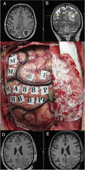 Imágenes de resonancia magnética en secuencia T1 axial con contraste (A) y T2 coronal (B), que muestran una tumoración correspondiente a glioblastoma situado en el parietal izquierdo, en el margen posterior del lóbulo central. Se empleó cirugía con mapeo cerebral intraoperatorio para la identificación de córtex motor (C) gracias a lo cual se logró una extirpación completa como muestra la secuencia T1. Resonancia magnética postoperatoria con (D) y sin contraste intravenoso (E) en ausencia de déficit neurológico postoperatorio.