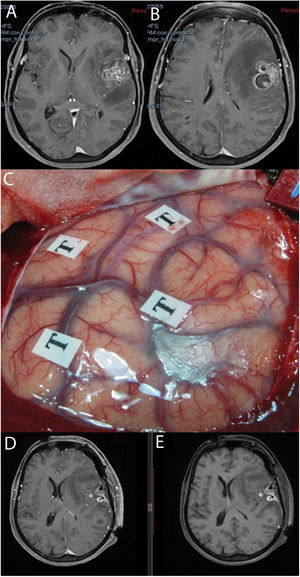 Imágenes de resonancia magnética en la secuencia T1 con contraste (A, B) que muestran una tumoración correspondiente a glioblastoma situada en la región opercular izquierda. Se empleó cirugía con mapeo cerebral intraoperatorio en paciente despierto (C). Las resonancias magnéticas postoperatorias con (D) y sin contraste intravenoso (E) muestran cambios posquirúrgicos, con restos hemáticos en ausencia de tumoración residual, todo ello sin que tuviera lugar un empeoramiento en el lenguaje.