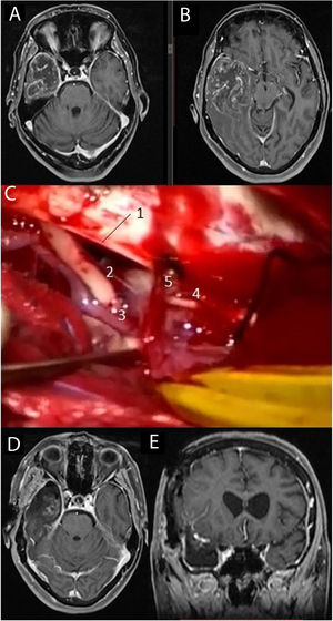 Imágenes de resonancia magnética en la secuencia T1 con contraste intravenoso (A, B) que muestran una voluminosa tumoración situada en el lóbulo temporal derecho, correspondiente a glioblastoma. Se practicó una lobectomía temporal (C), en la cual pueden diferenciarse el borde libre del tentorio (1), el III par craneal derecho (2), la arteria comunicante posterior derecha (3), el IV par craneal derecho (4) junto a una vena cortical que drena en el tentorio (5). Las imágenes D y E muestran respectivamente los cortes axial y coronal de la resonancia magnética postoperatoria.
