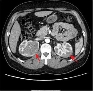 Corte axial de tomografía axial computarizada abdominal con contraste intravenoso. Se aprecia en ambos riñones masas hipodensas, mal definidas, infiltrativas que afecta fundamentalmente a la medular del riñón.