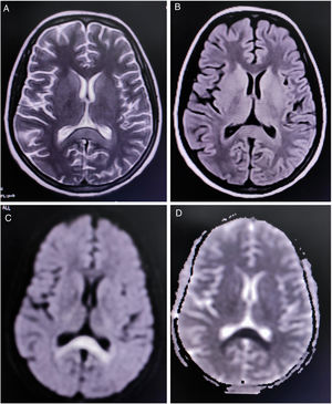 MRI of the brain showing non-enhancing hypertense lesion on axial T2-weighted image (A), and axial T2-FLAIR (B), with substantial diffusion restriction on diffusion-weighted imaging (C) and ADC (D) sequences, involving the splenium of the corpus callosum, suggestive of boomerang sign.