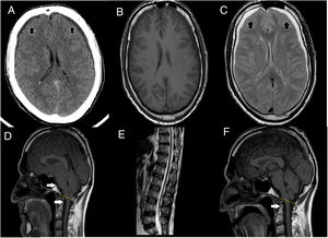 (A) Cranial CT scan shows bilateral subdural collections (as the black arrows point), without associated mass-effect, suggestive of subdural hygromas. (B, C) It stands out collapsed lateral ventricles, also bilateral subdural collections, hypointense in T1 (B), hyperintense in T2 (C) sequences (as the black arrows point), without enhancement after contrast administration, supporting the suspicion of subdural hygromas. (D) T1 weight sagittal sequence showed severe downward displacement of cerebellar tonsils (as the white arrows point) below the McRae line (represented by the yellow line), distortion of the brainstem structures and descent of the splenium of the corpus callosum. (E) Spinal MRI showing inferior and ventral displacement of the medullary cord. (F) Resolution of downward displacement of brainstem (as the white arrows point) and cerebellar structures (cerebellar tonsils are placed above the McRae line, represented by the yellow line). Resolution of the rest of the signs suggestive of brain sagging.
