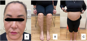 Six weeks after discontinued pregabalin facial edema (A), lower limbs edema (B), and thorax and abdomen edema (C) disappeared.
