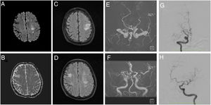 MRA diffusion weighted (A), apparent diffusion coefficient (B), FLAIR (C and D), and time of flight (E and F) images show a subacute ischemic stroke in left MCA territory, chronic ischemic events, and remarkably decreased blood flow in MCAs. Angiography (G and H) shows 60% stenosis of the proximal portion of the right ICA, complete occlusion of the right M1 segment, 70% stenosis of the left M1 segment, 50% stenosis of the left P1 segment, and collateral flow from the right ACA irrigating the territory corresponding to the posterior division of the right MCA.
