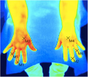 Rest Thermography (Case 1): Temperature increase greater than 1.5 degrees in the upper right limb with respect to the left at the points indicated.
