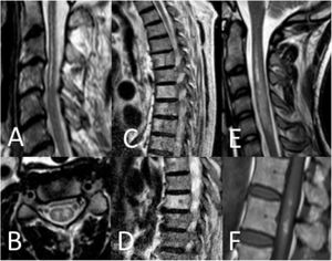 Hallazgos en RM medular. Patrón «lápiz» en secuencia potenciada T2 y corte sagital (A), patrón «ojos de lechuza» en secuencia potenciada en T2 y corte transversal (B), infartos vertebrales en secuencia potenciada en T2 y corte sagital (C y D), edema medular en secuencia potenciada en T2 y corte sagital (E) e infarto hemorragizado en secuencia potenciada en T1 y corte sagital (F).