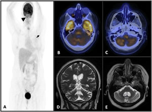 A maximum intensity projection (MIP) PET image (A) reveals no sign of residual malignant disease (arrows). Fusion PET-CT images of brain (B, C) show diffuse bilateral decreased 18 F-fluorodeoxyglucose (FDG) uptake in cerebellum. T2W coronal (D) and axial (E) brain MR imaging demonstrate diffuse cerebellar atrophy.