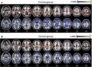 Averaged left A1-based functional connectivity maps of the (A) tinnitus and (B) control groups. The first row represents the positive correlation between the left A1 and whole brain, whereas the second row represents the negative correlation between the left A1 and whole brain. The hot colormap represents the brain areas that positively correlate with the left A1, whereas the winter colormap represents the brain areas that negatively correlate with the left A1. For visualization, the left A1-based connectivity maps of all patients or all controls are averaged and thresholded by the z value of |1|. The green area indicates the seed region. The connectivity between the left A1 and bilateral superior, middle, and medial frontal areas, middle and inferior temporal areas, inferior parietal areas, and subcortical areas as well as the right inferior parietal lobule is significantly negative in the tinnitus group (winter colormap in A) and not in the control group (gray color in B). The connectivity between the left A1 and bilateral somatosensory areas (winter colormap in A and B, z=25 and 31) is positive in both groups, but stronger in patients with tinnitus.