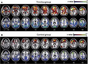 Averaged left DLPFC-based connectivity maps of the (A) tinnitus and (B) control groups. The first row represents the positive correlation between the left DLPFC and whole brain, whereas the second row represents the negative correlation between the left DLPFC and whole brain. The hot colormap represents the brain areas that positively correlate with the left DLPFC, whereas the winter colormap represents the brain areas that negatively correlate with the left DLPFC. For visualization, the left DLPFC-based connectivity maps of all patients or all controls are averaged and thresholded by the z value of |1|. The green area indicates the seed region. The tinnitus group (A) showed significantly positive (hot colormap in top row) and negative (winter colormap in bottom row) DLPFC connectivity with more extensive areas compared with the control group (B).