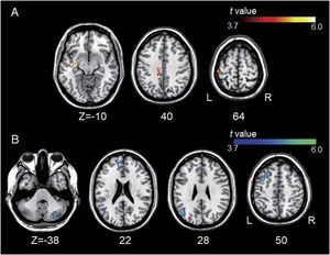 Group differences between left A1-based connectivity maps. (A) The hot colormap represents the brain areas with significantly increased positive connectivity of the left A1 in the tinnitus group compared with the control group. These regions include the left middle temporal, cingulate, and postcentral areas. (B) The winter colormap represents the brain areas with significantly increased negative connectivity of the left A1 in the tinnitus group compared with the control group. These regions include the left superior, middle, and medial frontal and angular areas and right cerebellar areas.