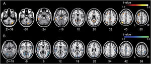 Group differences between the left DLPFC-based connectivity maps. (A) The hot colormap represents the brain areas with significantly increased positive connectivity in the tinnitus group compared with the control group. The regions include the bilateral posterior cingulate cortex, parahippocampal areas, and midbrain, right cerebellum, bilateral angular areas extending to the precuneus, middle temporal area, inferior parietal lobule, and inferior temporal areas, and left frontal and anterior cingulate areas. (B) The winter colormap represents the brain areas with significantly increased negative connectivity in the tinnitus group compared with the normal group. The regions include bilateral temporo-occipital, parietal (e.g., the precuneus and postcentral and inferior parietal lobules), cingulate, and cerebellar areas.