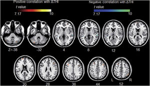 Association between tinnitus improvement (ΔTHI) and the left A1-based connectivity maps of the tinnitus group. The hot colormap represents the positive correlation between the ΔTHI and left A1-based connectivity maps. The winter colormap represents the negative correlation between the ΔTHI and left A1-based connectivity maps. Tinnitus improvement was estimated by subtracting the pre-rTMS THI scores from the post-rTMS THI scores. Thus, a low ΔTHI (hot colormap) indicates a good rTMS outcome, whereas a high ΔTHI (winter color map) indicates a poor rTMS outcome. An rTMS outcome is poor when the connectivity between the left A1 and bilateral frontal cortices is similar to that of the control subjects (i.e., stronger connectivity [hot colormap]). An rTMS outcome is good when the connectivity between the left A1 and bilateral temporal cortices is strong (winter color map).