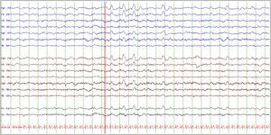 EEG basal con presencia de ondas delta intermitentes frontales (FIRDA). Electroencefalograma basal, vigilia tranquila con ojos cerrados. Montaje longitudinal bipolar, LFF 0,5Hz, HFF 30Hz, sensibilidad 10 uV/mm, tiempo de base 15mm/s. Sobre una actividad de base dentro de límites normales, destaca la presencia de ondas delta de gran voltaje en derivaciones frontales bilaterales de aparición intermitente (FIRDA) tanto aisladas como en trenes de pocos segundos (línea roja).