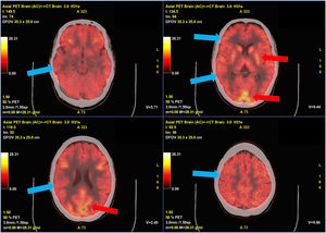F18-FDG PET-TC cerebral con presencia de hipometabolismo cortical generalizado. Tomografía por emisión de positrones con F18-fluordesoxiglucosa fusionado con TC cerebral. Se aprecia un hipometabolismo generalizado difuso en la corteza cerebral (flechas azules), con mayor captación de trazador en los ganglios de la base que en la corteza, así como algunos focos corticales occipitales con captación normal del trazador (flechas rojas).
