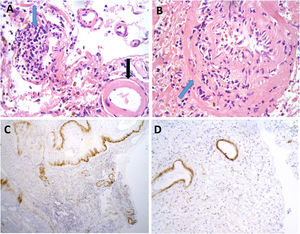Hallazgos neuropatológicos en la biopsia cerebral de uno de los casos de inflamación relacionada con angiopatía amiloide (paciente 3). Vasos de leptomeninge con paredes engrosadas, hialinas (A, flecha negra). Existen infiltrados inflamatorios linfocitarios que focalmente se encuentran invadiendo la pared de vasos sanguíneos con datos focales de cariorrexis (A y B, flechas azules). No se identifica necrosis fibrinoide, células gigantes ni granulomas. Las paredes de los vasos engrosados muestran positividad inmunohistoquímica para Beta amiloide (C y D).