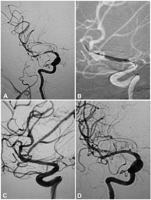 A 53-year-old woman had an atherosclerotic stenosis (78%) at the M1 segment of the right middle cerebral artery (MCA) treated with the angioplasty and stenting of the Low-Profile Visualized Intraluminal Support (LVIS) stent. (A) The stenosis was shown at the M1 segment. (B) A balloon was used to dilate the stenosis before stenting. (C) At the end of the stenting with a LVIS stent (3.5mm×15mm), the stenotic segment was restored to the normal diameter. (D) At 12-month follow-up, the stented segment of artery remained totally open with no instent stenosis.