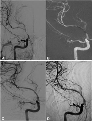A 64-year-old man had an atherosclerotic stenosis (75%) at the M1 segment of the right middle cerebral artery treated with angioplasty and stenting of the Low-Profile Visualized Intraluminal Support (LVIS) stent. (A) The stenosis was shown at the M1 segment. (B) A balloon was used to dilate the stenosis before stenting. (C) At the end of the stenting with a LVIS stent (3.5mm×15mm), the stenotic segment was almost restored to the normal diameter. (D) At 6-month follow-up, the stented segment of artery remained totally open with slight instent stenosis.
