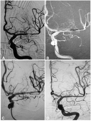A 55-year-old woman had an atherosclerotic stenosis (83%) at the M1 segment of the left middle cerebral artery treated with angioplasty and stenting of the Low-Profile Visualized Intraluminal Support (LVIS) stent. (A) The stenosis was shown at the M1 segment. (B) A balloon was used to dilate the stenosis before stenting. (C) At the end of the stenting with a LVIS stent (3.5mm×15mm) deployed, the stenotic segment was almost restored to the normal diameter. (D) At 12-month follow-up, the stented segment of artery remained patent.