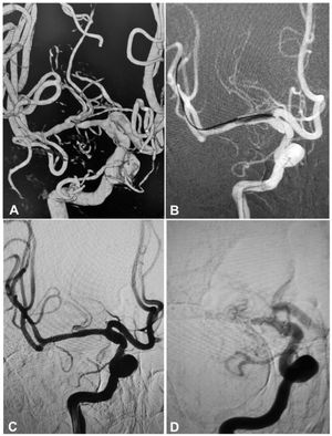 A 54-year-old man had an atherosclerotic stenosis (88%) at the M1 segment of the right middle cerebral artery treated with angioplasty and stenting of the Low-Profile Visualized Intraluminal Support (LVIS) stent. (A) The stenosis was shown at the M1 segment. (B) A balloon was used to dilate the stenosis before stenting. (C) At the end of the stenting with a LVIS stent (3.5mm×15mm), the stenotic segment was almost restored to the normal diameter. (D) At 6-month follow-up, the stented segment of artery was totally occluded with no symptoms.