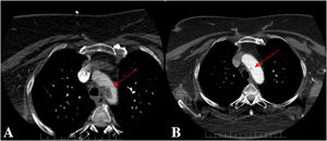 Axial CT angiography images showing a hypodense fibrolipid plaque at the level of the aortic arch (red arrow). (A) Baseline evaluation at admission (29.3mm×12.7mm×15.3mm). (B) Follow-up evaluation 6 weeks later (7.45mm×8.35mm×4.7mm).