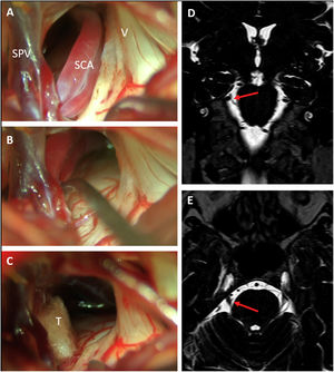 Right trigeminal neuralgia caused by a descending loop of the superior cerebellar artery (SCA) as seen on preoperative coronal (D) and axial (E) DRIVE-MRI sequences. Microsurgical inspection revealed a double arterial loop corresponding to the superior and inferior branches of the SCA compressing the superomedial portion of the trigeminal nerve (A). After dissection of the arachnoid adhesions, the arteries could be transposed cranially (B) and held in place with a Teflon pledget (C). SPV: Superior petrosal vein; SCA: Superior cerebellar artery; V: Fifth cranial nerve; T: Teflon pledget.