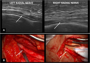 (A) High-resolution ultrasound image of the left and right radial nerves (at the midarm level). (B) Intra-operative photographs of the right radial nerve with visible torsion and constriction. Site of constriction indicated by arrows.
