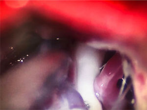 Conflicto neurovascular de grado3 (indentación) entre la arteria cerebelosa superior y la zona de entrada de la raíz en el microscopio quirúrgico durante una descompresión microvascular en un paciente con neuralgia del trigémino V2 refractaria (Hospital de la Santa Creu i Sant Pau).