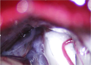 Fragmento de teflón interpuesto entre el nervio trigémino y una rama arterial de la arteria cerebelosa superior durante una descompresión microvascular en una paciente con neuralgia del trigémino V2 refractaria (Hospital de la Santa Creu i Sant Pau).