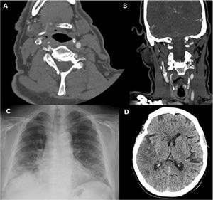 Paciente 8. A. Reconstrucción coronal de angio-TC, con un trombo endoluminal sobre placa de ateroma (flecha blanca) en la Arteria Carótida Interna Derecha (ACI). B. TAC de cráneo sin contraste, con signos de infarto cerebral en el territorio de la ACM derecha. C. angio-TC axial, trombosis aguda en ACI Derecha (flecha blanca). D. Estudio de control pasadas 4 semanas: Angio-TC axial, signos de resolución del trombo endoluminal, la placa de ateroma subyacente determinaba una estenosis residual del 30%.
