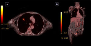 PET-CT images (Positron emission tomography co-registered with computarized tomography). Axial (A) and coronal (B) sections. Hypermetabolic pulmonary nodule in the right upper lobe, suggestive of malignancy.