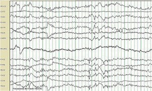 EEG que muestra una encefalopatía difusa con superimposición de brotes de ondas lentas (delta) rítmicas hipervoltadas en regiones centrales bilaterales y en vértex.
