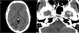 Imagen axial de la tomografía computarizada (A y B) realizada en el momento del diagnóstico. A) Se observan dos áreas de hipodensidad parenquimatosa occipitales derechas, ambas con afectación córtico-subcortical y focos de sangrado reciente en su interior. B) Tras la administración de contraste se observa defecto lineal de repleción inespecífico en la arteria basilar; no se aprecian otras alteraciones relevantes en los troncos supraaórticos ni las arterias intracraneales.