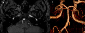 Imagen axial de angiografía por resonancia magnética con secuencia TOF 3D realizada a los tres meses que muestra defecto de repleción lineal en tercio inferior de la arteria basilar (A) y reconstrucción que muestra dicha alteración, pudiendo corresponder a una fenestración incompleta (B).