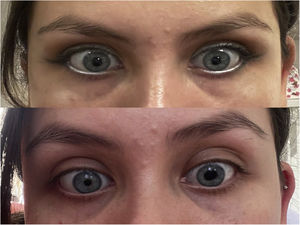 Fotos de la paciente. En la imagen superior se observan las pupilas simétricas. En la inferior se observa una pupila izquierda midriática y discórica. Las fotos fueron tomadas por la paciente.
