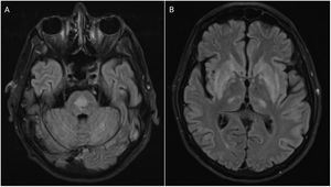 Axial fluid-attenuated inversion recovery magnetic resonance imaging (FLAIR MRI) demonstrating a centrally located area of increased signal in the pons (A) and a moderately homogeneous signal enhancement bilaterally symmetrical in the basal ganglia with symmetrical foci of enhancement in the posterior thalami (B), typical for pontine (A) and extrapontine (B) myelinolysis or osmotic demyelination syndrome.