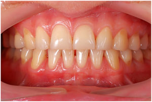 Ejemplo de paciente con un periodonto sano.