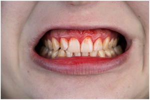 Ejemplo de paciente con gingivitis.