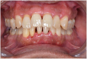 Ejemplo de paciente con periodontitis.