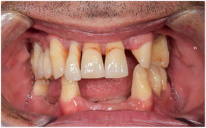Ejemplo de paciente con pérdida dentaria asociada a periodontitis avanzada.