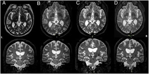 Axial and frontal views of a postoperative 3D T2-weighted MRI (A) and 1 month (B), 1 year (C) and 3 years (D) MRI controls showing left MRI-guided focused ultrasound (MRIgFUS) thalamotomy. L (left side). R (right side).