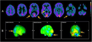 Exploración de medicina nuclear mediante PET [18F]FDG. A)Cortes axiales seleccionados en los que se visualiza hipometabolismo en tálamo, encrucijada temporo-parieto-occipital bilateral de predominio derecho y en el hemisferio cerebeloso derecho (flechas amarillas). B)Imágenes proyectadas mediante mapas 3D-stereotactic surface projection que comparan los hallazgos anteriores con una base de pacientes normales de acuerdo con la edad, en las que se confirma lo anteriormente descrito. Las regiones hipometabólicas se representan en color azul.
