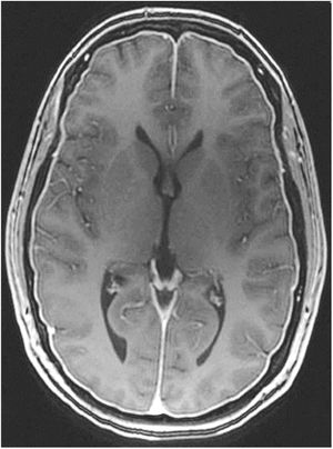 Captación paquimeníngea de contraste, difusa y homogénea, en la RM craneal de una mujer de 42 años con SHI espontáneo confirmado por manometría de LCR mediante punción lumbar. Cortesía del Dr. Belvís. Servicio de Neurología, Hospital de la Santa Creu i Sant Pau. Barcelona.
