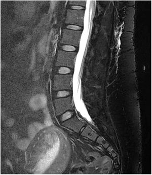 Colección de LCR en tejidos blandos lumbares en una mujer de 34 años con SHI posprocedimiento de anestesia espinal preparto. Cortesía del Dr. Belvís. Servicio de Neurología, Hospital de la Santa Creu i Sant Pau. Barcelona.