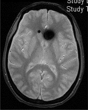 Colección de fluido subdural (hematoma subdural) en la convexidad parietooccipital en un hombre de 46 años con HIE posprocedimiento de anestesia espinal por cirugía en una rodilla. Cortesía del Dr. Belvís. Servicio de Neurología, Hospital de la Santa Creu i Sant Pau. Barcelona.