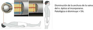 Ecografía transorbitaria. Adaptada de Fichtner et al.63.