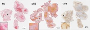 Cortes histológicos de trombo de paciente con ictus isquémico con las siguientes tinciones: hematoxilina-eosina (H&E); Martius Scarlet Blue (MSB); e inmunotinción específica para inhibidor de la fibrinólisis activable por trombina (TAFI). Se marcan con (*) las áreas ricas en plaquetas y con (#) las zonas ricas en eritrocitos. En la esquina inferior derecha de cada imagen se facilita un aumento ×20 de las áreas señaladas. Fuente: Imágenes cedidas por el Laboratorio de Aterotrombosis, CIMA/Universidad de Navarra.