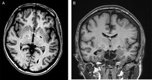 RMI postoperatoria axial (A) y coronal (B) adquirida después de 2lesiones (palidotomía izquierda/subtalamotomía derecha).