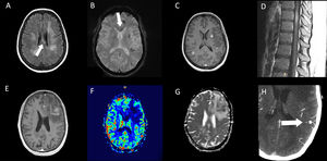 Resonance imaging findings of two different patients. Patient 5 (top row): multiple hyperintense white matter lesions are shown in FLAIR image (A), with involvement of corpus callosum (arrows). Signs of hemorrhage on the gradient echo sequence (B) and enhancement after gadolinium injection in T1-weighted image (C) are present in some lesions. In dorsal spinal cord, an enhanced lesion is seen in a sagital T1-weighted image (D). Patient 3 (bottom row): A left frontal lesion with mass effect shows heterogeneous contrast enhancement in T1-weighted image (E). Lesion is hipovascular in perfusion sequence (F) and shows diffusion restriction in ADC map (G). Angio-CT image shows a left parietal leptomeningeal aneurism (thick arrow) (H).
